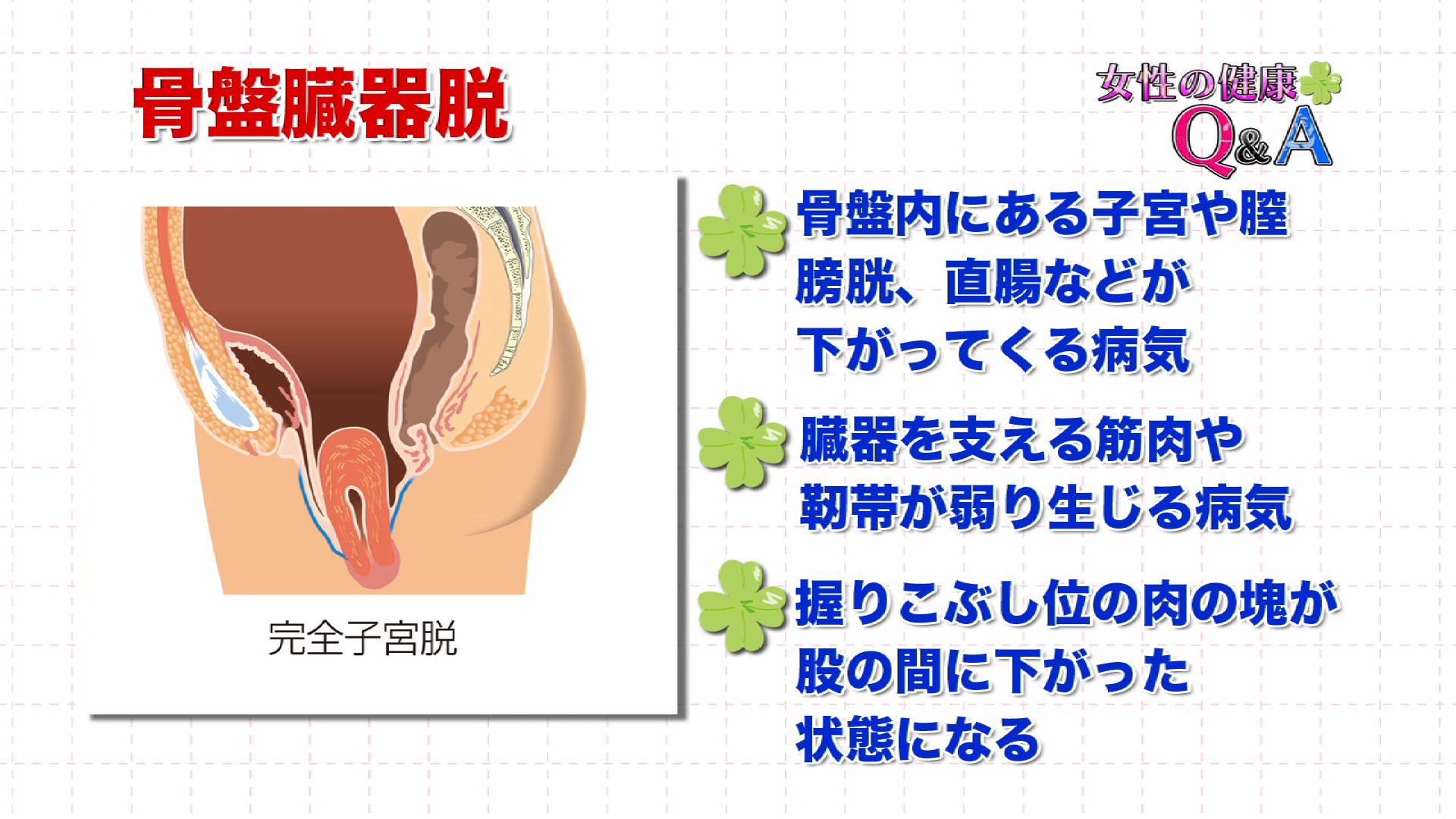 9月6日 骨盤臓器脱 女性の健康q A