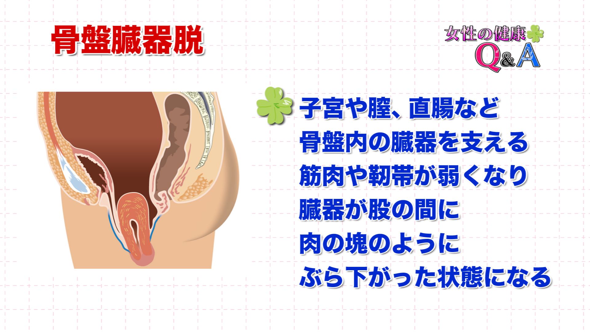 9月日 骨盤臓器脱の治療法 女性の健康q A