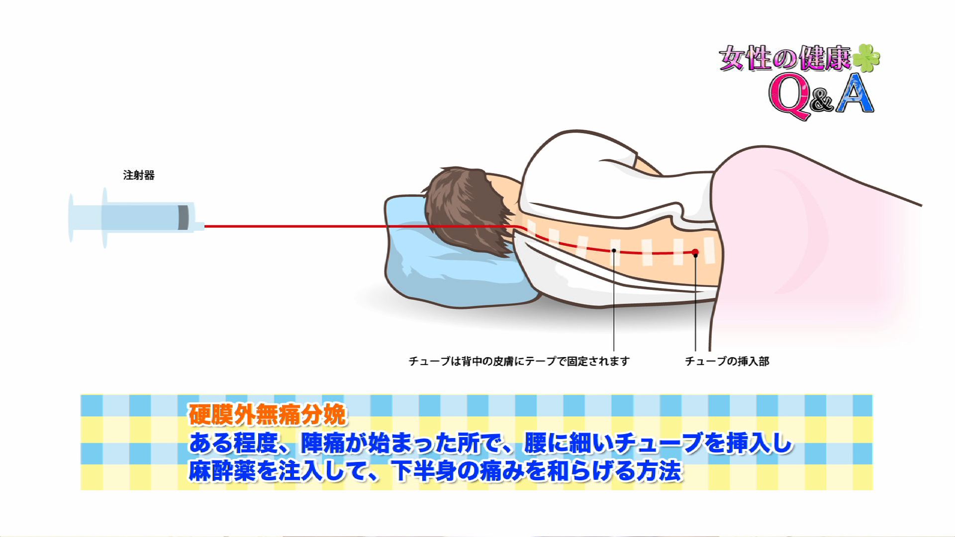 7月5日 無痛分娩 女性の健康q A